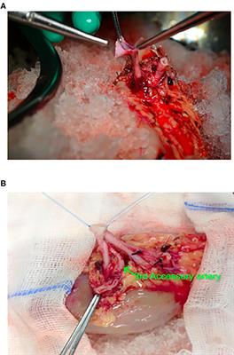 Feasibility and Functional Outcome of Robotic Assisted Kidney Transplantation Using Grafts With Multiple Vessels: Comparison to Propensity Matched Contemporary Open Kidney Transplants Cohort